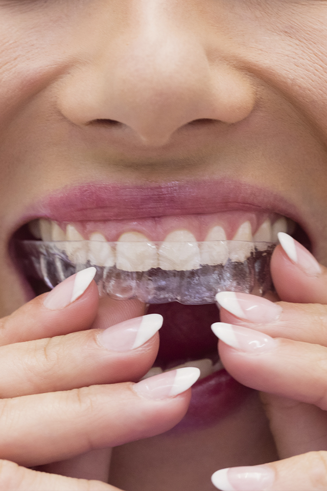 Alineadores dentales invisaling #1
