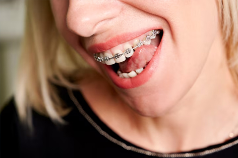Frenillos - Brackets