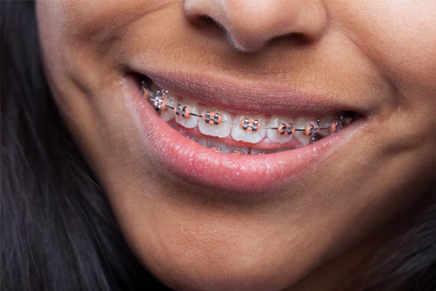 Frenillos - Brackets Doctor Vainer #3 Frenillos - Brackets