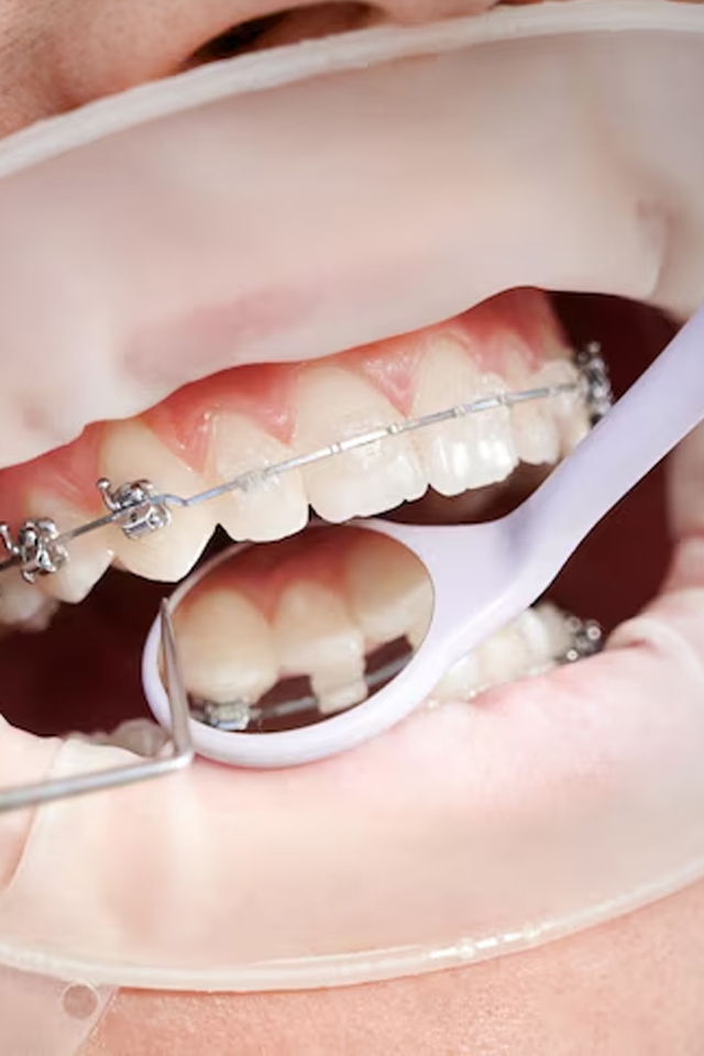 Frenillos - Brackets Doctor Vainer #6