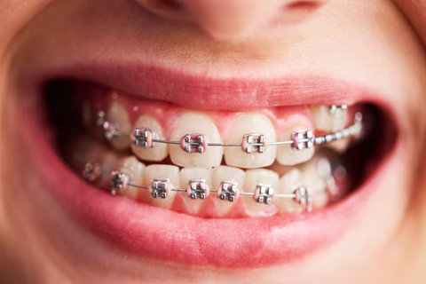 Frenillos - Brackets Doctor Vainer Frenillos - Brackets